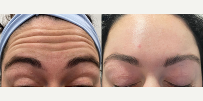 Botox before and after photo