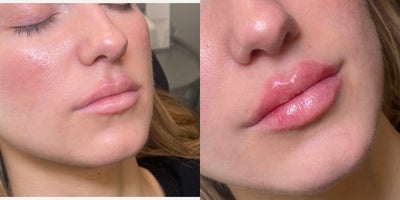 Dermal Fillers before and after photo