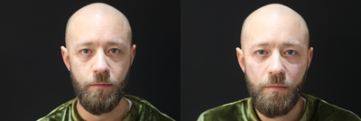 Eyelid Surgery before and after photo