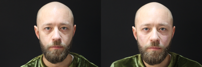 Eyelid Surgery before and after photo
