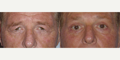 Eyelid Surgery before and after photo
