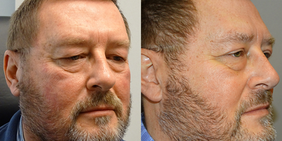 Ptosis Surgery before and after photo