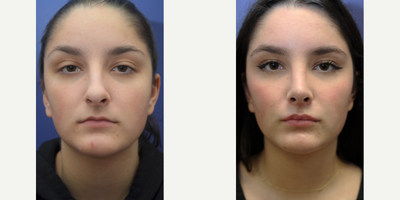 Rhinoplasty before and after photo