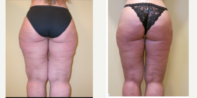 Brazilian Butt Lift before and after photo