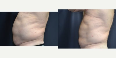 Emsculpt before and after photo