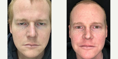 Eyelid Surgery before and after photo