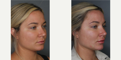Juvederm before and after photo