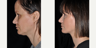 Liposuction before and after photo