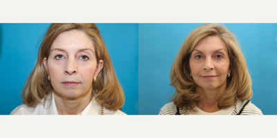 Mini Facelift before and after photo