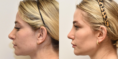 Revision Rhinoplasty before and after photo