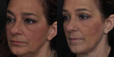 Eyelid Surgery before and after photo