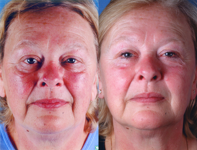 IPL before and after photo