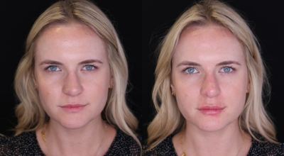 Lip Fillers before and after photo