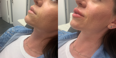 Lip Fillers before and after photo