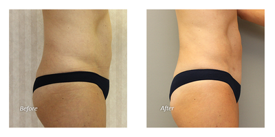 Liposuction before and after photo