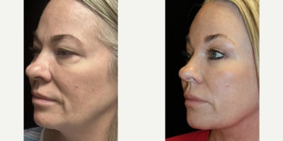 Neck Lift before and after photo