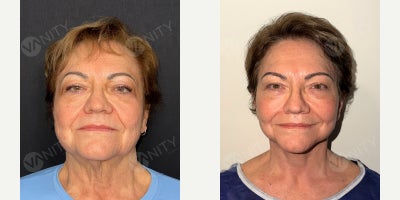 Deep Plane Facelift before and after photo