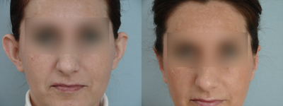Ear Surgery before and after photo
