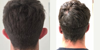 Ear Surgery before and after photo