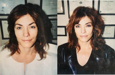 Eyelid Surgery before and after photo