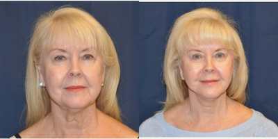 Facelift before and after photo
