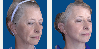 Facelift before and after photo