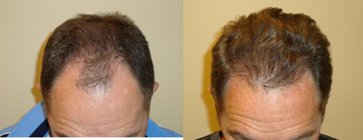 Hair Transplant before and after photo