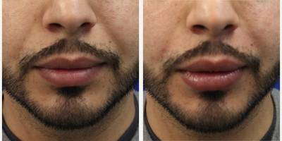 Juvederm before and after photo
