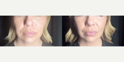 Chin Filler before and after photo
