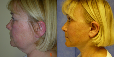 Facelift before and after photo