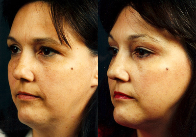 Brow Lift before and after photo