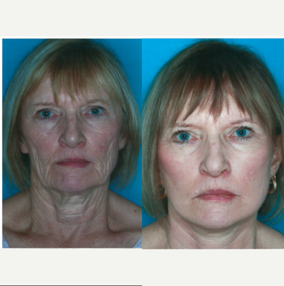 Facelift before and after photo