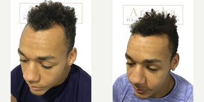 FUE Hair Transplant before and after photo