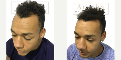 FUE Hair Transplant before and after photo