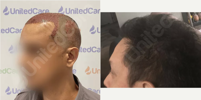 Hair Transplant before and after photo