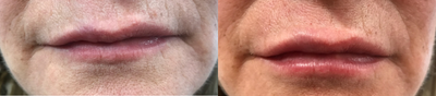 Juvederm before and after photo
