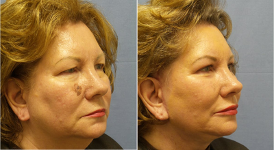 Laser Resurfacing before and after photo
