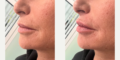Lip Fillers before and after photo