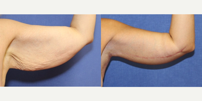 Arm Lift before and after photo
