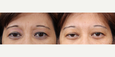 Botox before and after photo