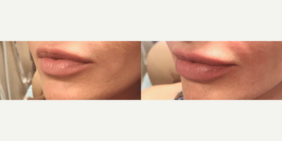 Lip Fillers before and after photo
