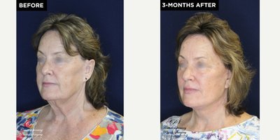 before and after image
