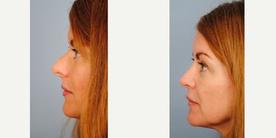 Rhinoplasty before and after photo