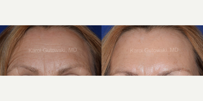 Botox before and after photo