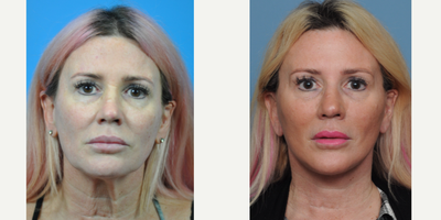 Facelift before and after photo