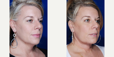 Neck Lift before and after photo