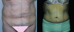 Panniculectomy before and after photo