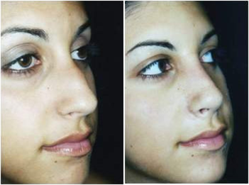 Rhinoplasty before and after photo
