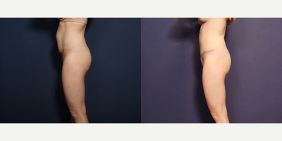 Tummy Tuck before and after photo