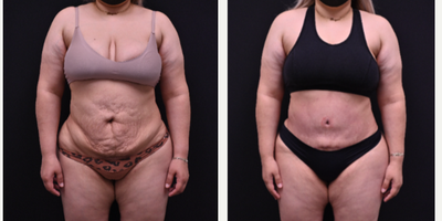 Tummy Tuck before and after photo